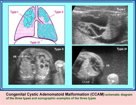 Congenital Cystic Adenomatoid Malformation Department Of Obstetrics And Gynecology Faculty Of