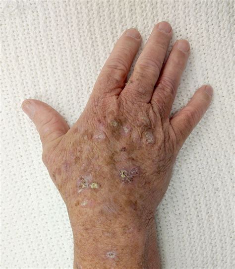 Actinic Keratosis MEDizzy