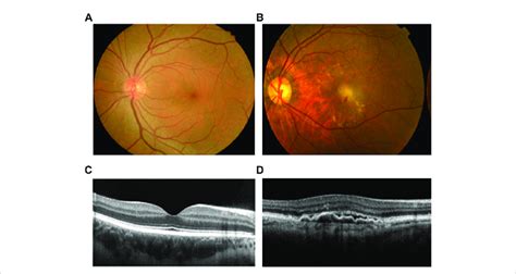 Comparison Of Health And Amd Human Retina A Normal Human Fundus