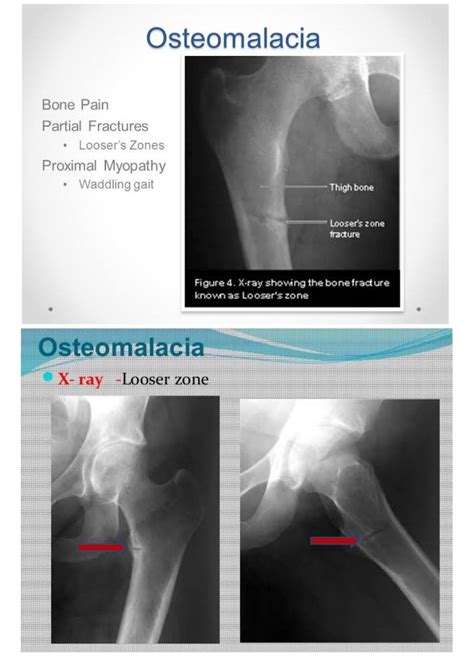 Osteomalacia X Ray