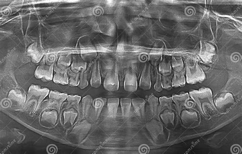 X Ray Of Child Teeth Stock Photo Image Of Dentistry 76618006