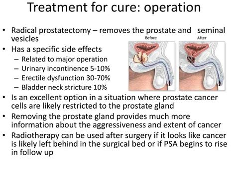 Ppt Everything You Need To Know About Prostate Radiotherapy During The Talk Or At End Send