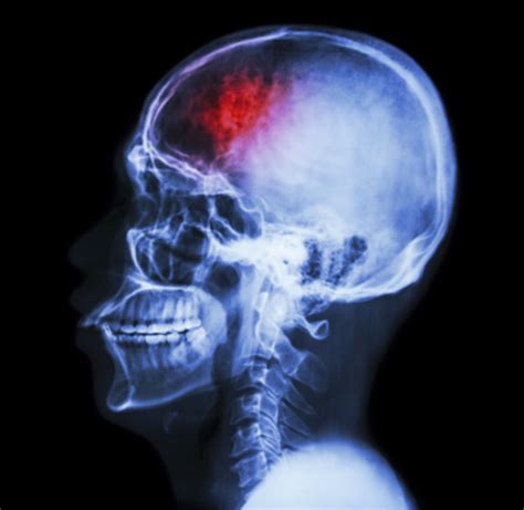 TBI 101: About Traumatic Brain Injury | BrainLine