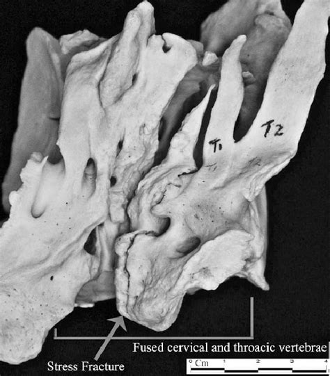 Completely fused cervical vertebrae with fracture of the pedicle of the ...