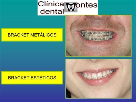 Comparativa entre brackets estéticos y brackets metálicos en sonrisa