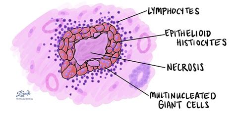 Chronic Inflammation Emedicodiary