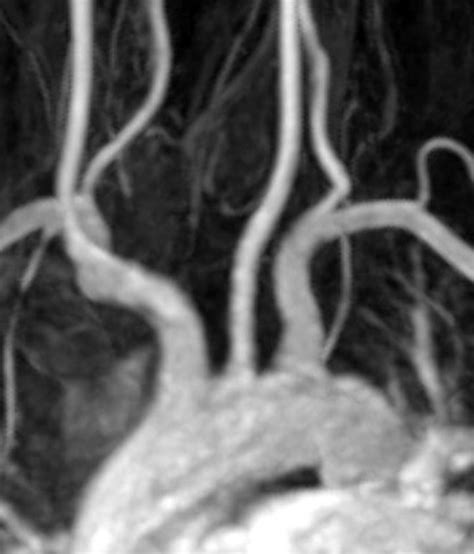 Aortic arch anomalies MRI - wikidoc