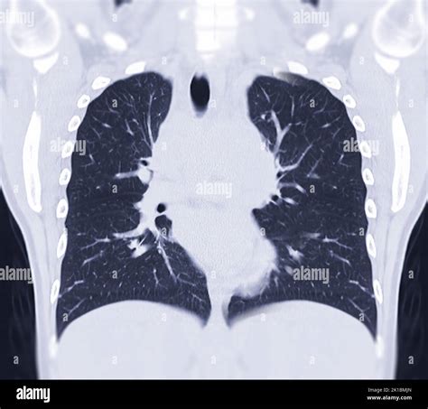 CT Chest Coronal MIP Ansicht für diagnostische Lungenembolie PE