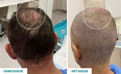 Haartransplantation Ohne Rasur DHI Vienna