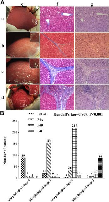 Morphologic Severity Of Cirrhosis Determines The Extent Of Liver