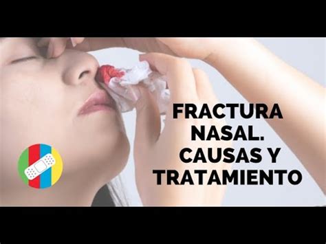 FRACTURA NASAL Causas Y Tratamiento YouTube