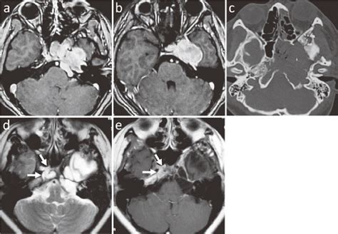 Case A B Preoperative Enhanced Axial Mri Showing A Clival Tumor