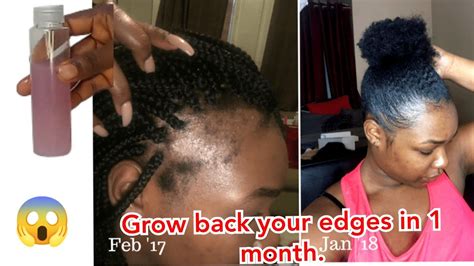 Regrow Your Edges And Baldspots How To Regrow Your Edges Hairline