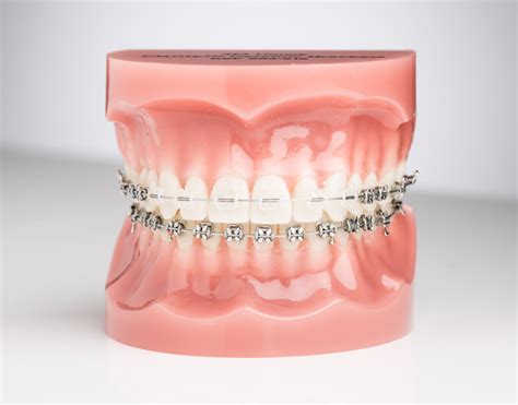 My Braces Doctor | Traditional Ceramic Braces in Alexandria