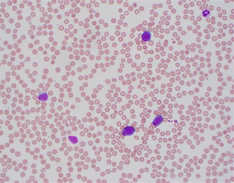 Pathology Outlines - Burkitt lymphoma