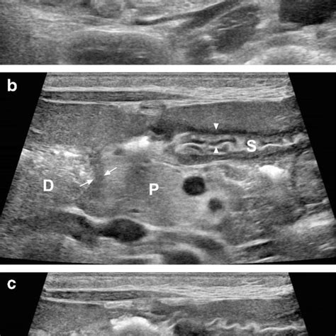 A B Sagittal A And Transverse B Ultrasound Images Of The Upper