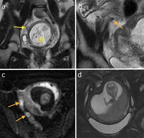 Mri Pregnancy Scan Pregnancywalls