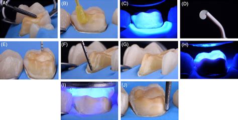 Significance Of Immediate Dentin Sealing And Flowable Resin Coating