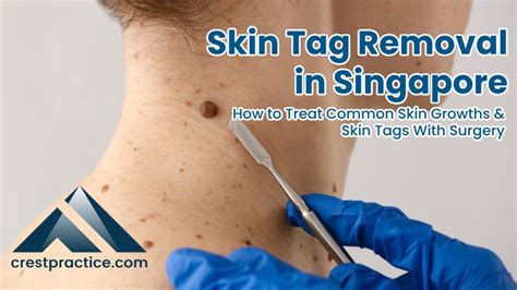 Effective Surgery Solutions for Skin Tags, Lipomas, and Cysts