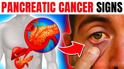 12 Early Warning Signs Of Pancreatic Cancer You Are Ignoring Youtube