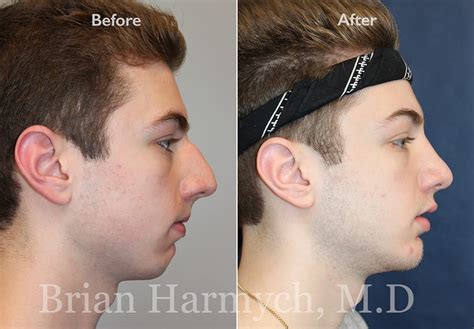 Rhinoplasty Photos 2 Rhinoplasty Before And After Photos