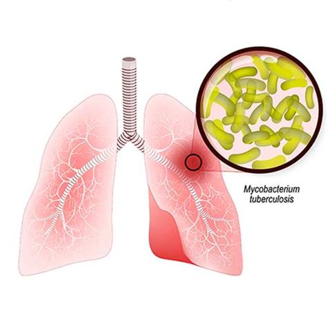 Tuberculosis - Symptoms, Causes and Treatment of Tuberculosis