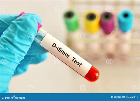 Blood Sample Tube For D Dimer Test Stock Image Image Of Care Vein