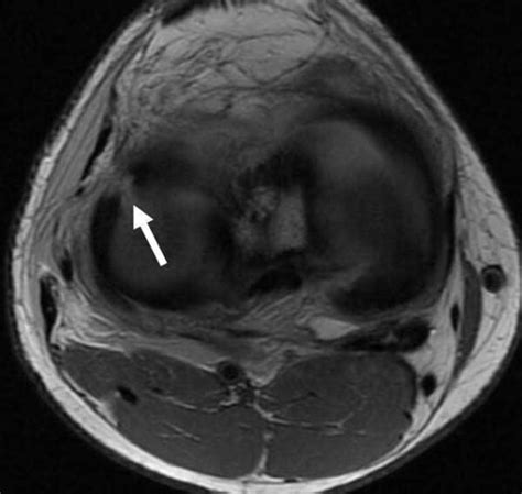 How to Read an MRI of a Radial Meniscus Tear | Sports Medicine Knee Specialist | Minnesota