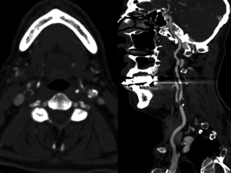 Angio Ct Of The Carotids In A Patient With Bilateral Calcifications Download Scientific Diagram