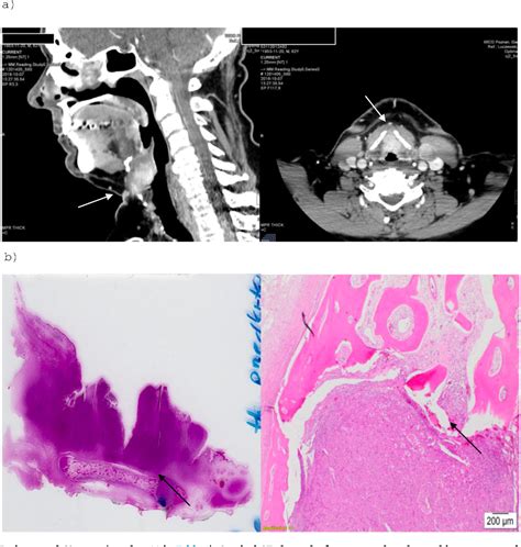 Figure 1 From Assessment Of Cartilage Invasion In Case Of Laryngeal