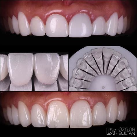 Intraoral Photos Of My Previous Post Dull Zirconia Veneers Were