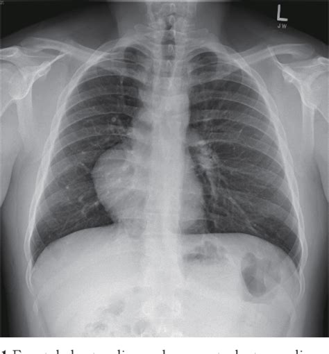 Figure 1 From Transarterial Embolization Of Intralobar Pulmonary