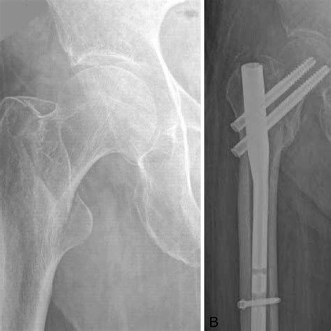 Anteroposterior X Ray View Of A 66 Year Old Female Patient Showing A