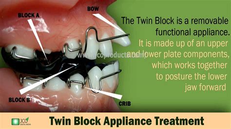 Dental Twin Block Appliancewmv Youtube