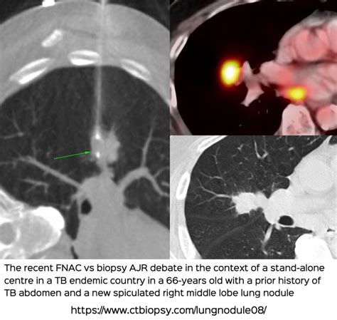 Lung Nodules - 20-50 mm - CT Guided Biopsy