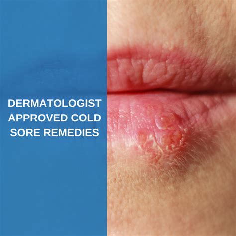 Dermatologist Approved Cold Sore Remedies - Savannah River Dermatology