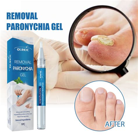 Ekousn Nail Fungal Liquid Pen Onychomycosis Paronychia Toe Fungus Hand