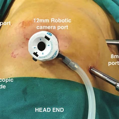 Port Placement For Laparoscopic Hysterectomy Download Scientific Diagram