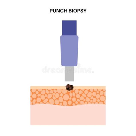 Punch biopsy procedure stock vector. Illustration of melanoma - 274593974