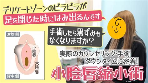 【小陰唇縮小術】はみ出るビラビラが気になるので手術しました＊密着＊【湘南美容クリニック】 Youtube