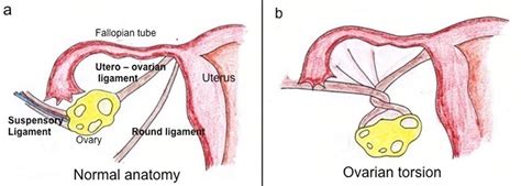 Ovarian torsion causes, symptoms, diagnosis & ovarian torsion treatment