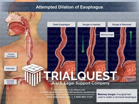 Attempted Dilation Of Esophagus Trial Exhibits Inc