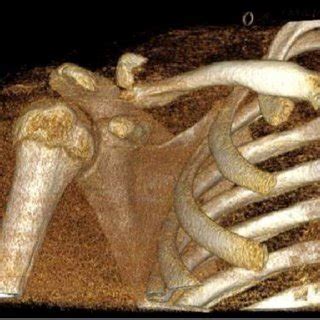 Computed Tomography Scan Three Dimensional Reconstruction Showing