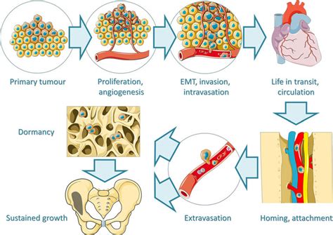 Main Steps In Tumour Initiation Progression And Bone Metastasis