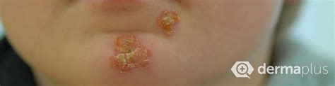 Borkenflechte Impetigo Contagiosa Ursachen Therapie Derma Plus