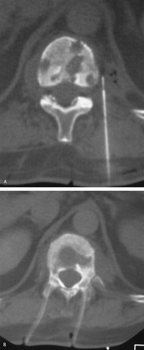 AB A Percutaneous Computed Tomography CT Guided Drainage Of