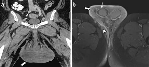 Scrotal Hidradenitis Supporativa A 54 Year Old Male With Scrotal Download Scientific Diagram