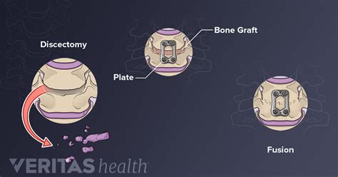 ACDF Surgery Procedure