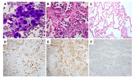 A Cytology Fine Needle Aspiration Fna Findings Of The Patient S