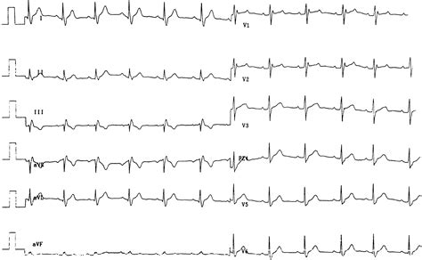 Evaluation Of The Specificity Of Morphological Electrocardiographic